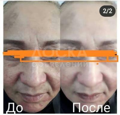 Гирудотерапия!