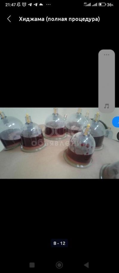 Хиджама (кровопускание) в Бишкеке: полная процедура 20 банок всего за 800с!