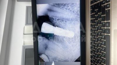 Имплантация зубов