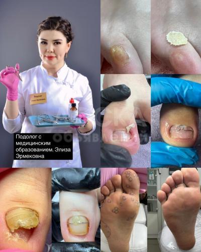 Лечение проблемных ногтей 0703818484